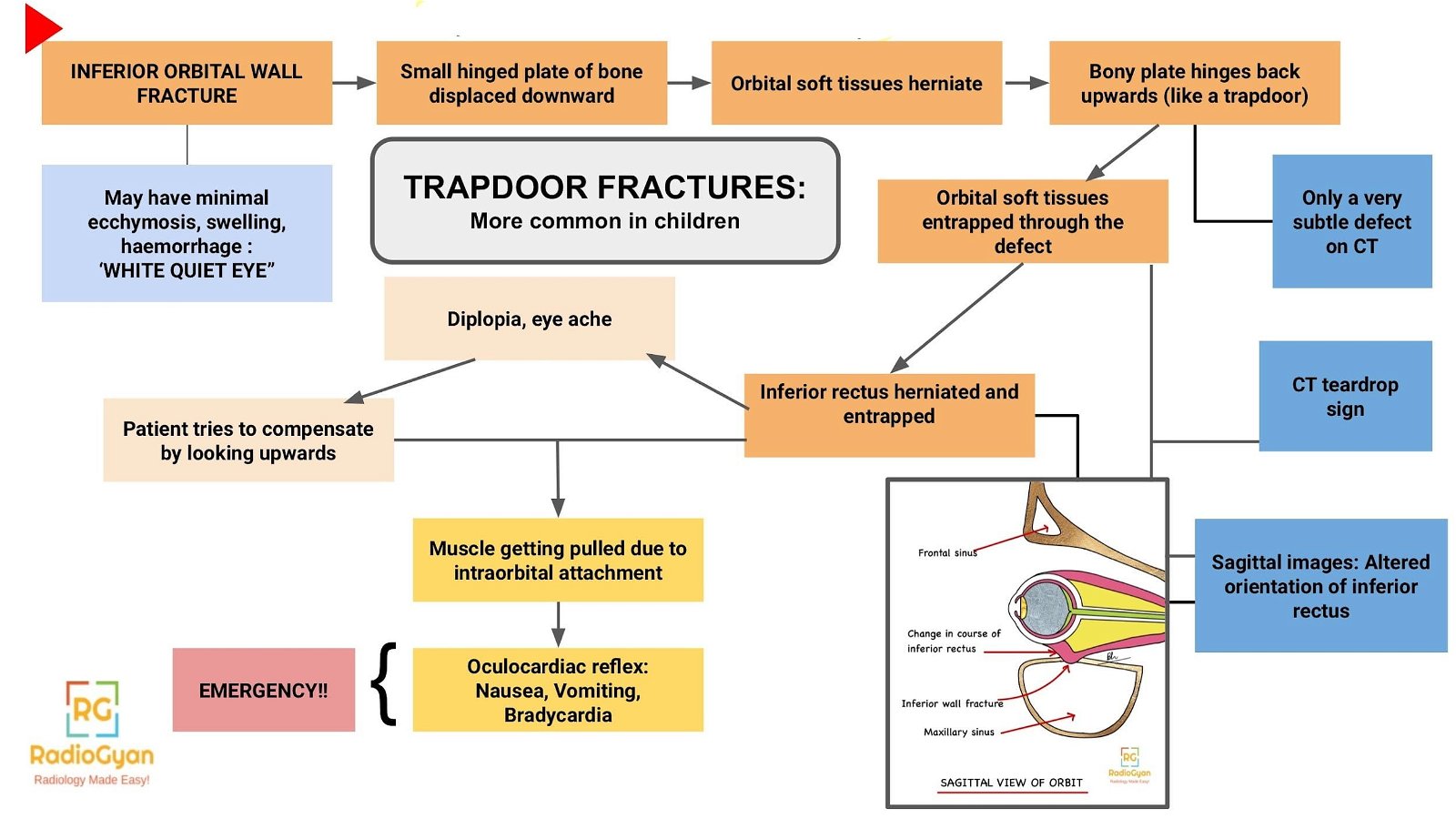 Trapdoor Orbital Fractures Pathophysiology