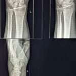 Triquetral Avulsion Fracture Radiology Case