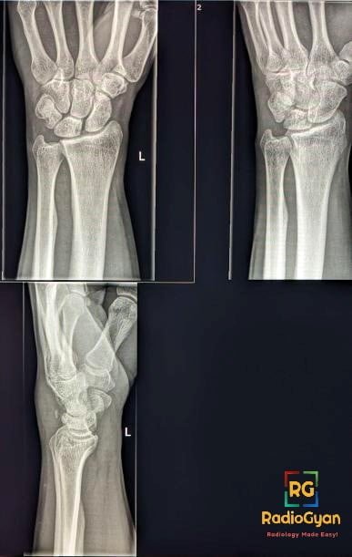 Triquetral Avulsion Fracture Radiology Case