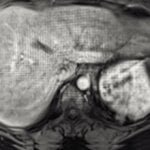 Transient Respiratory Motion Artifact During Arterial Phase MRI With Gadoxetate Disodium