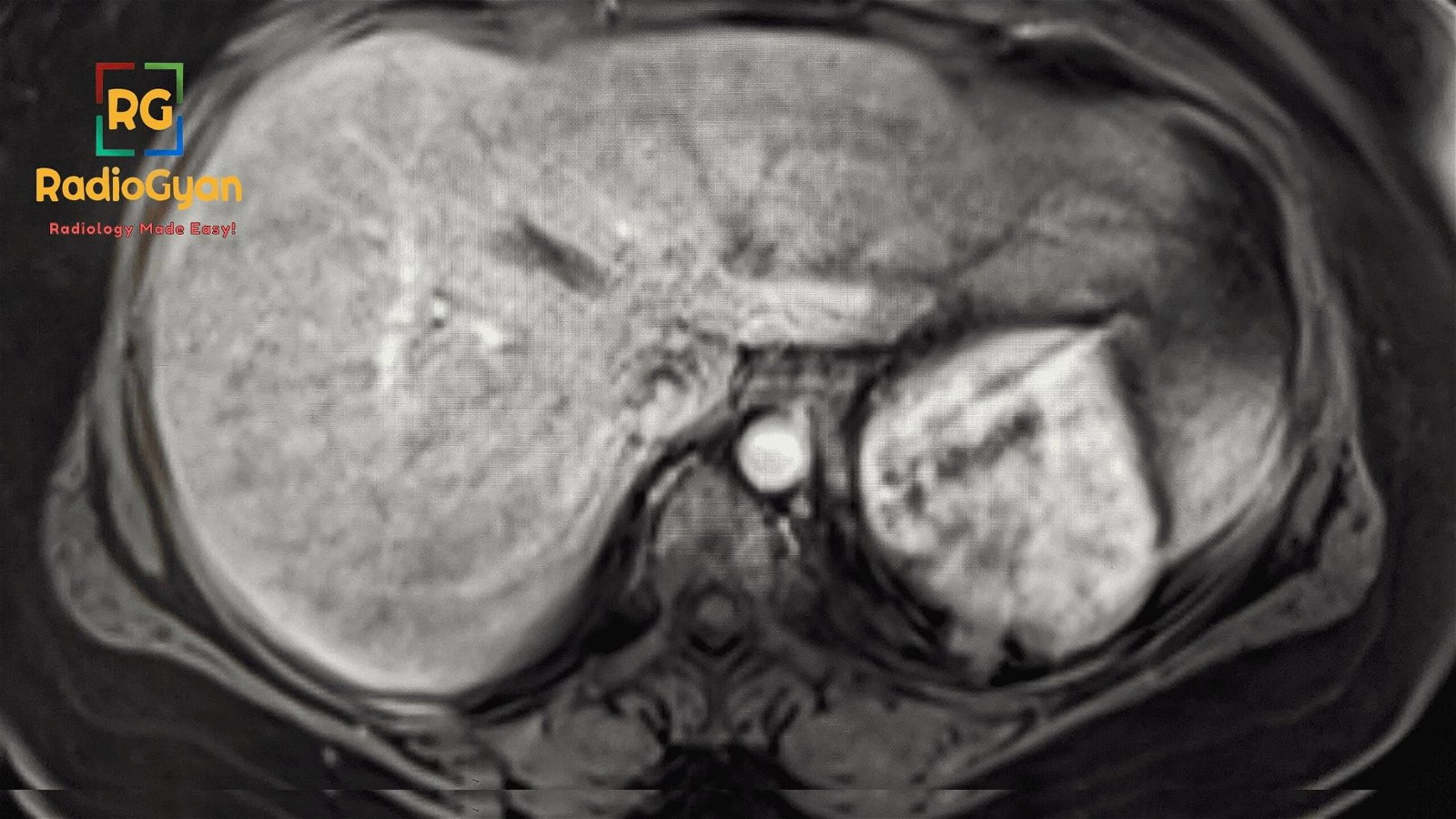 MRI image showing Transient Respiratory Motion Artifact During Arterial Phase MRI With Gadoxetate Disodium