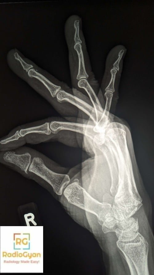 Lateral radiograph showing prominent carpal boss at the level of the carpometacarpal joints.