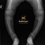 Radiograph of a child showing typical imaging features of rickets: bowing, metaphyseal cupping, splaying, and fraying