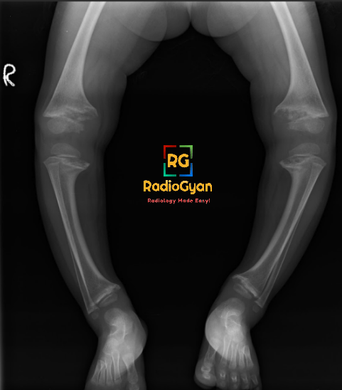 Radiograph of a child showing typical imaging features of rickets: bowing, metaphyseal cupping, splaying, and fraying