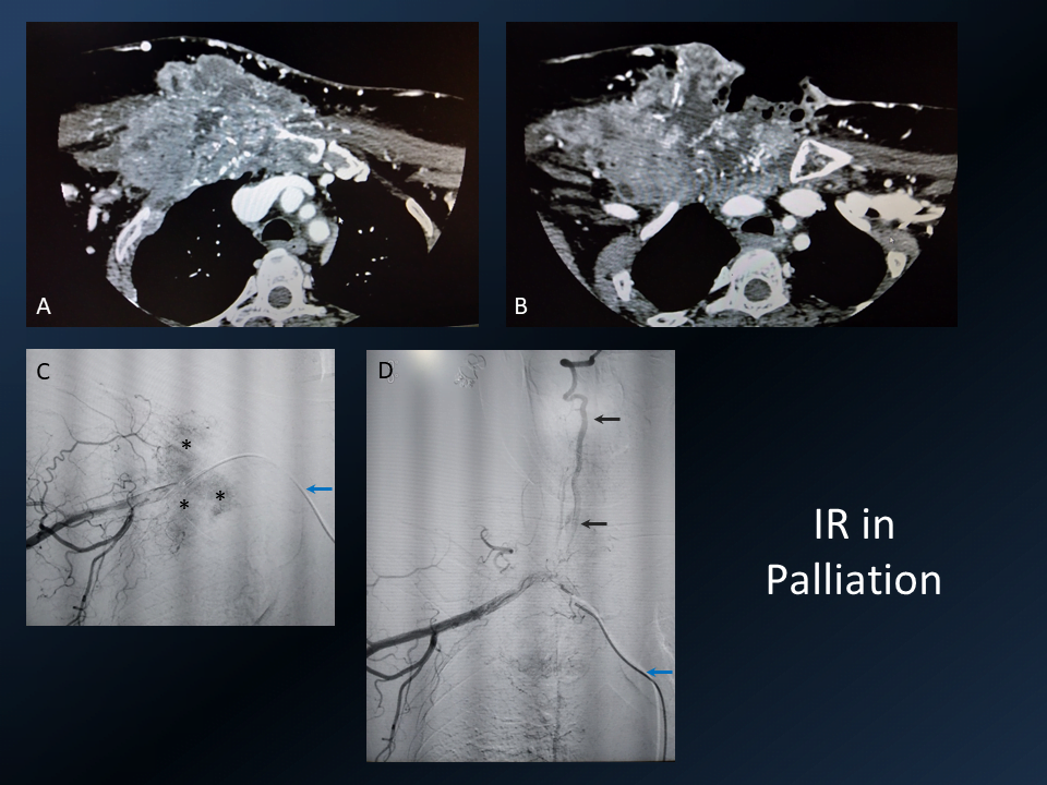 Palliative embolization of bleeding metastatic lesion Interventional Radiology